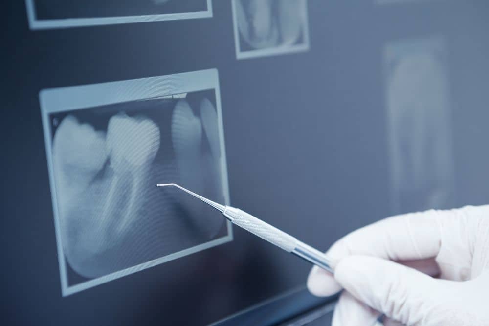 bone grafting in Dawsonville